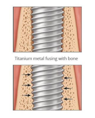  Osseo-Integraal Titanium: De Superheld van de Implantaatwereld?